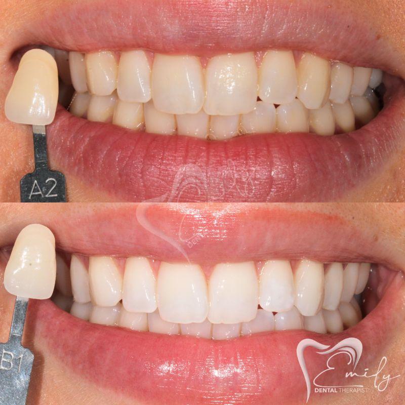 Before and after tooth whitening 
