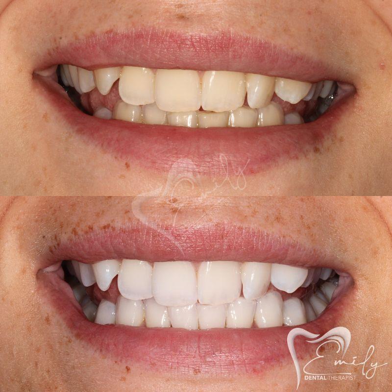 Before and after tooth whitening 