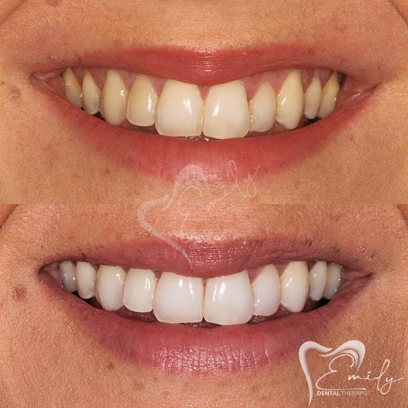 Before and after tooth whitening 